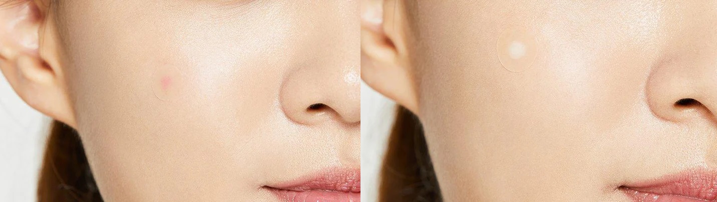 Náplast COSRX Acne Pimple Master Patch hojivé náplasti 24 ks