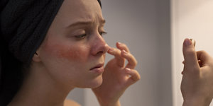 rosacea