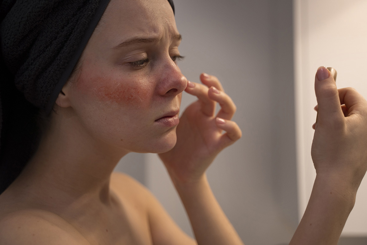 Růžovka - rosacea