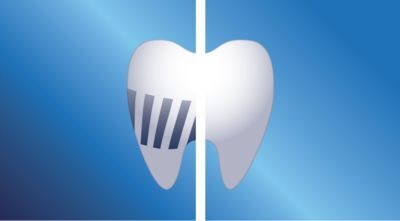 Removes up to 99.9% of plaque Removes up to 99.9% of plaque