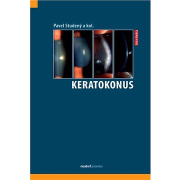 

Keratokonus