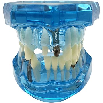 

Verk 01964 Model zubních implantátů, modrý