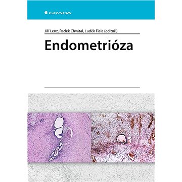 Endometrióza (978-80-271-3050-4)