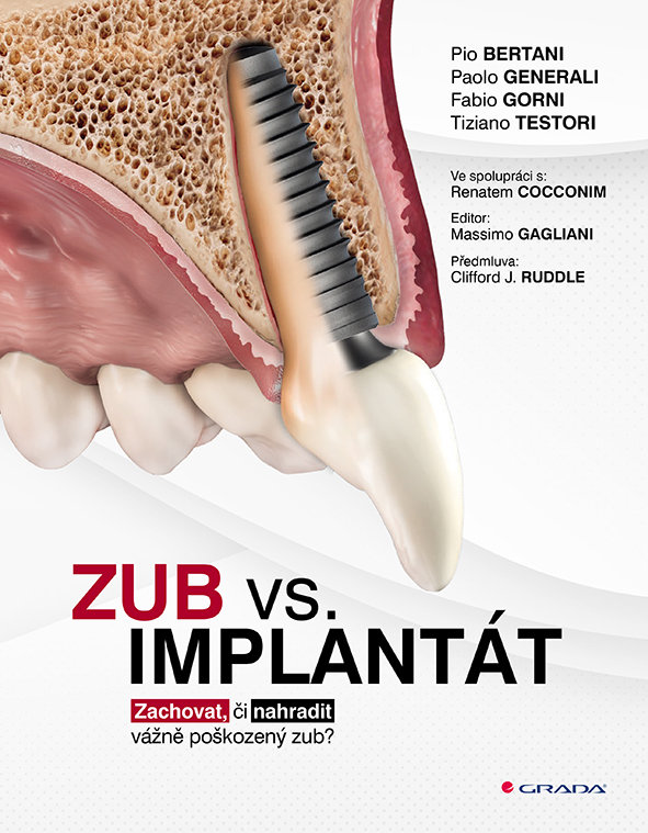Zub vs. implantát: Zachovat, či nahradit vážně poškozený zub?