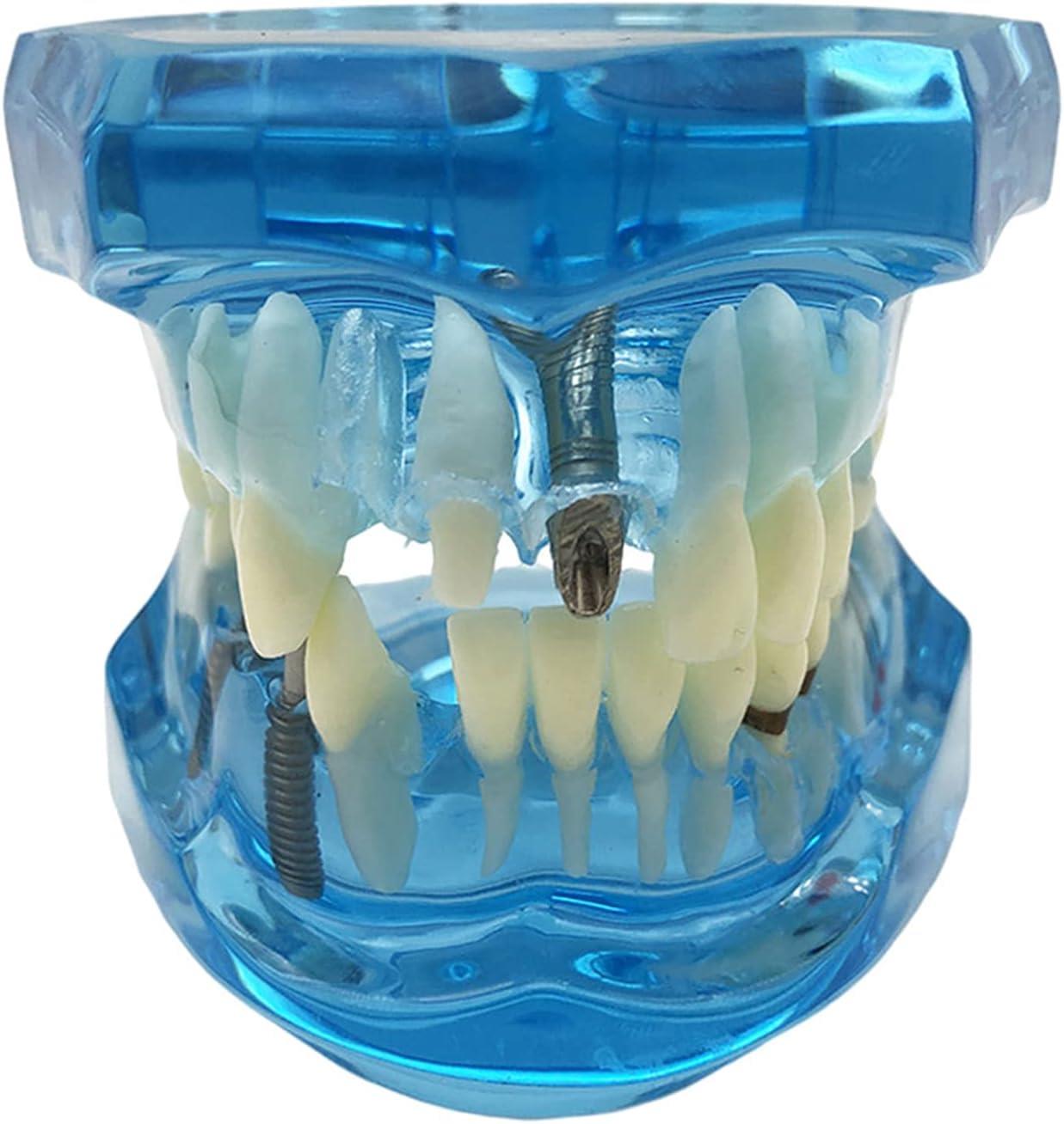 Model zubních implantátů Verk 01964